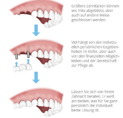 Schematische Darstellung eines festsitzenden Zahnersatzes für drei fehlende Zähne mit 2 einteiligen Implantaten