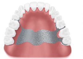 Schematische Darstellung einer herkömmlichen, herausnehmbaren Lösung des Ersatzes von 3 feglenden Zähnen im Oberkiefer
